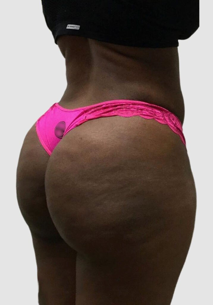 Before and after results of BBL procedure performed by Dr. Magna. after