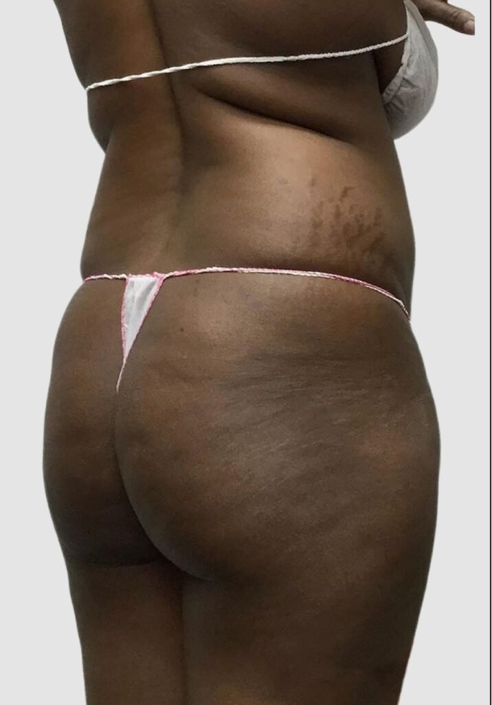 Before and after results of BBL procedure performed by Dr. Magna. before