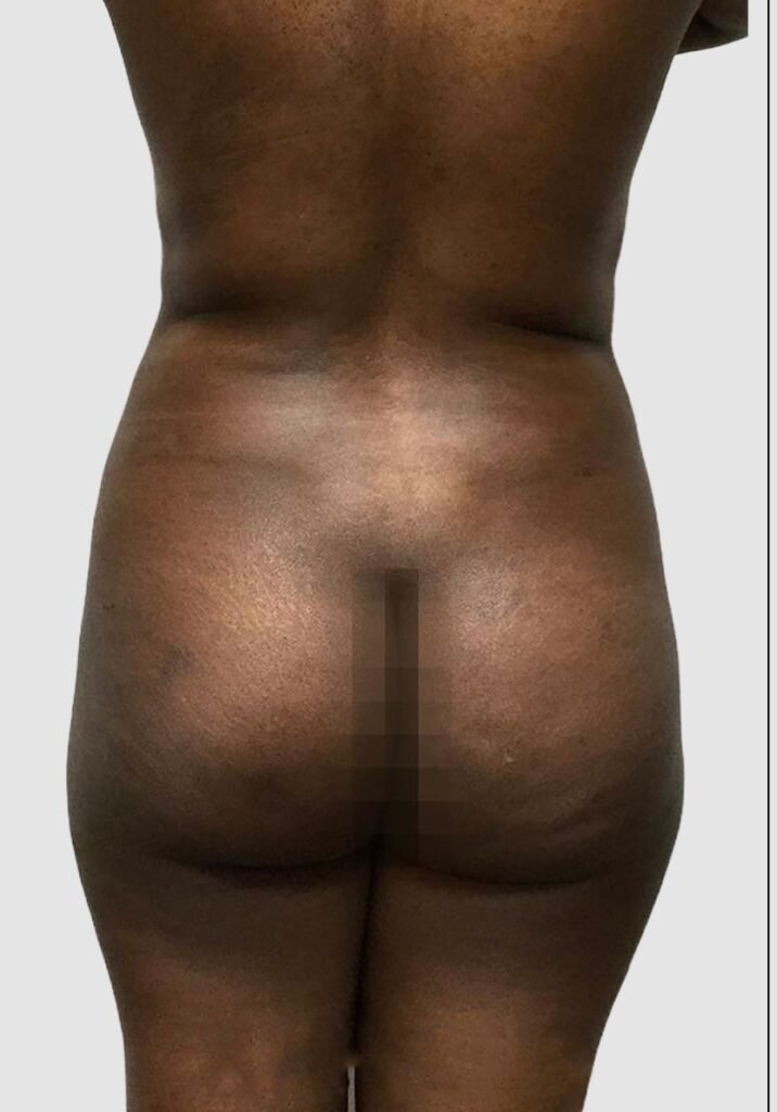 Before and after results of BBL procedure performed by Dr. Magna. before