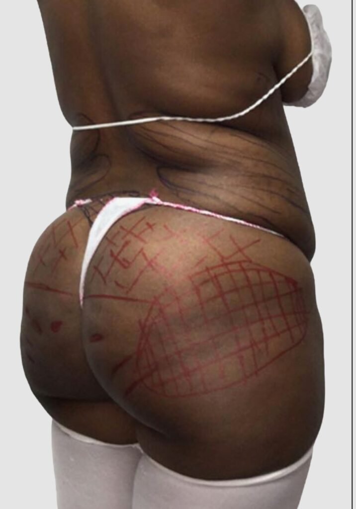 Before and after results of BBL procedure performed by Dr. Magna. before