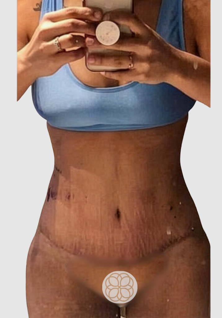 Before and after results of a combined liposuction/abdominal contouring and breast augmentation case performed by Dr. Magna. after