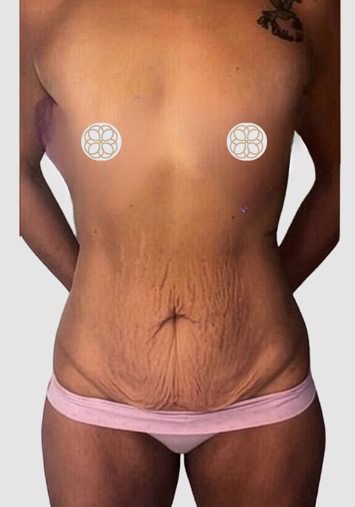 Before and after results of a combined liposuction/abdominal contouring and breast augmentation case performed by Dr. Magna. before