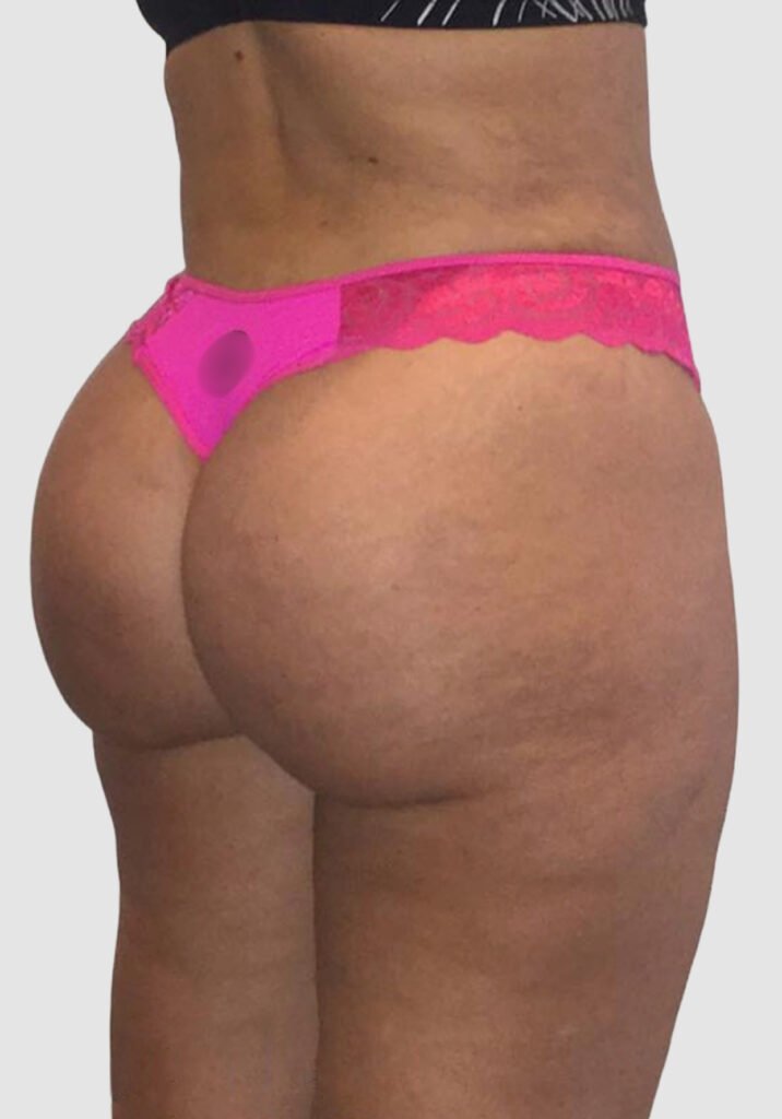 Before and after results of BBL procedure performed by Dr. Magna. after