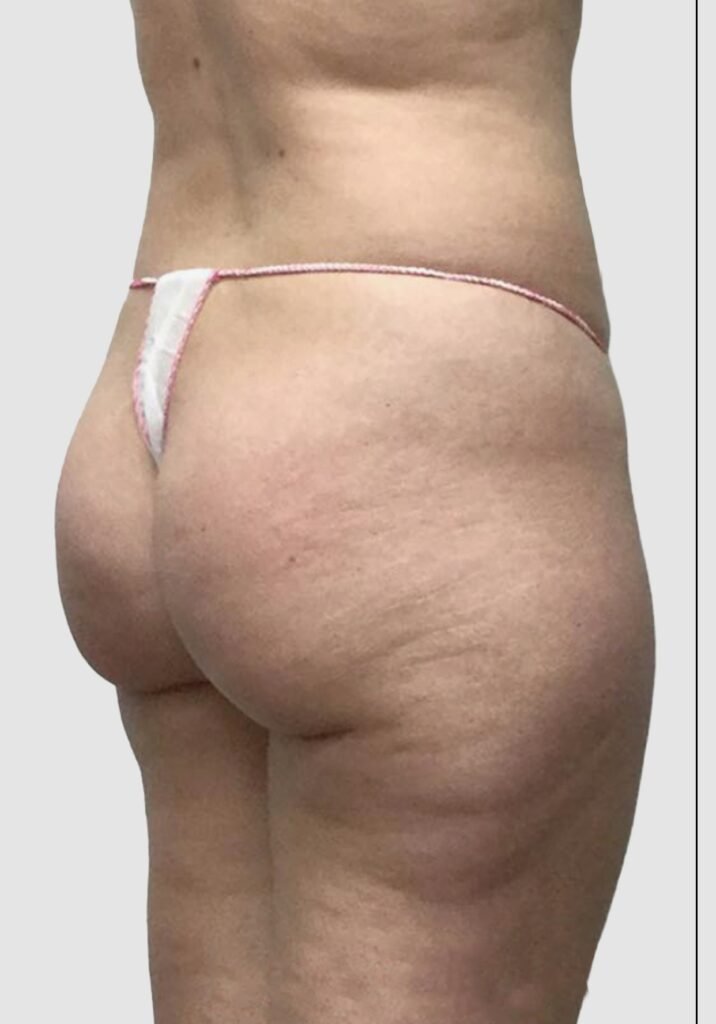 Before and after results of BBL procedure performed by Dr. Magna. before