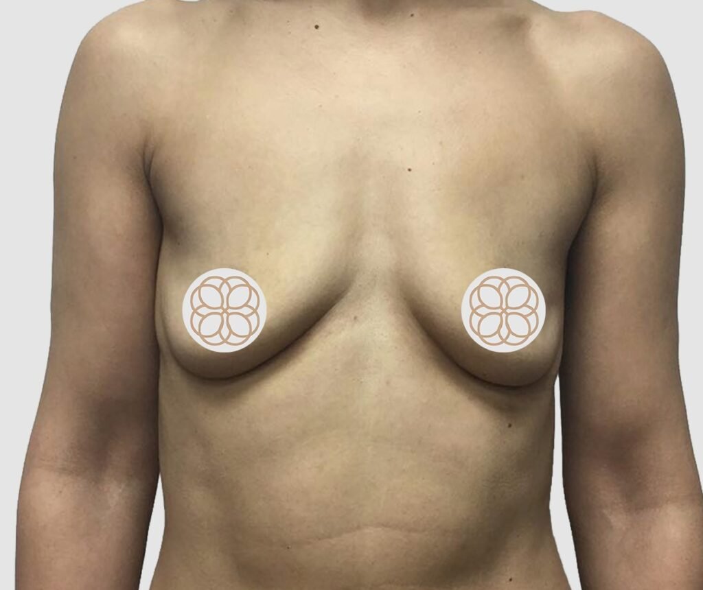 Before and after results of breast augmentation performed by Dr. Magna. before