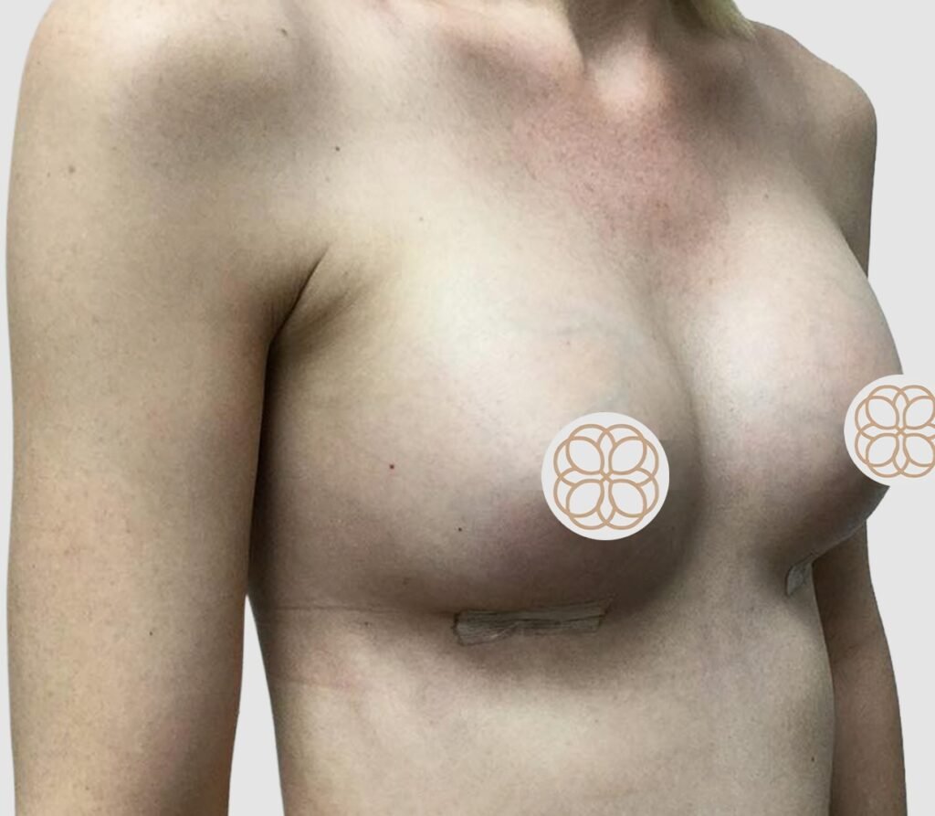 Before and after results of breast augmentation performed by Dr. Magna. after