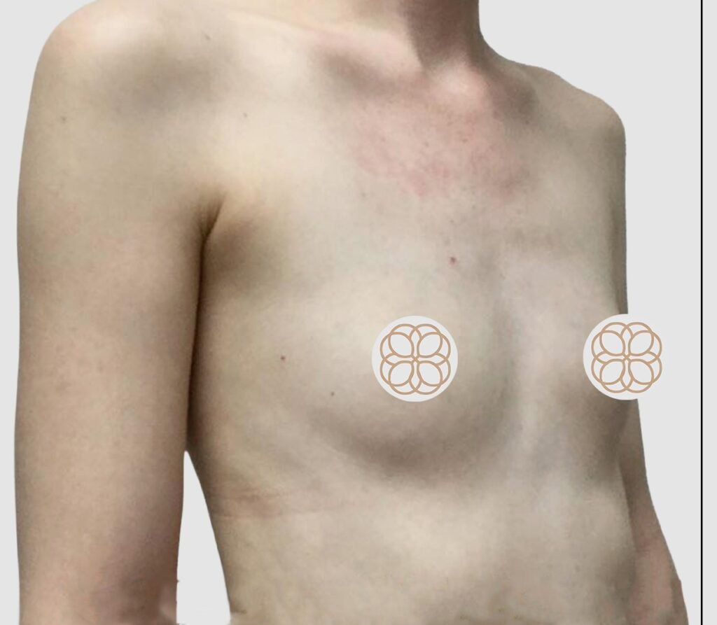 Before and after results of breast augmentation performed by Dr. Magna. before