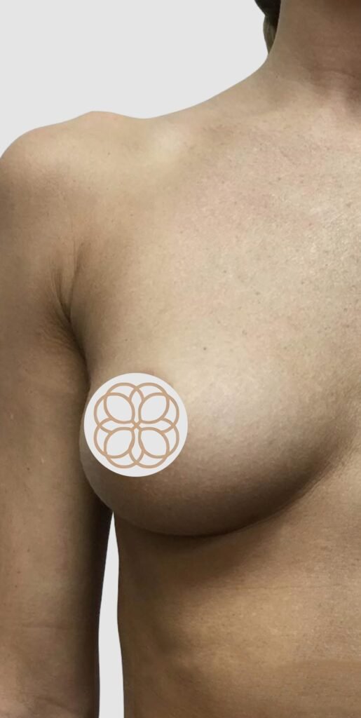 Before and after results of breast augmentation performed by Dr. Magna. before