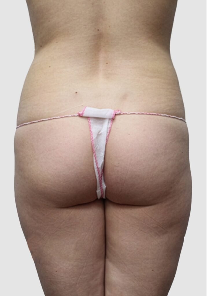 Before and after results of BBL procedure performed by Dr. Magna. before