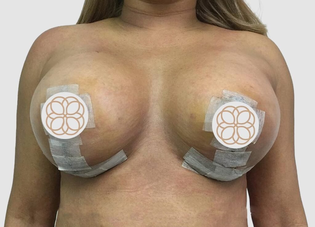 Before and after results of breast augmentation performed by Dr. Magna. after