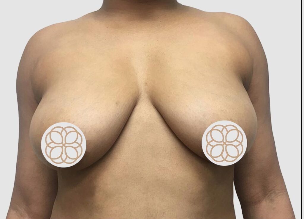 Before and after results of breast augmentation performed by Dr. Magna. before