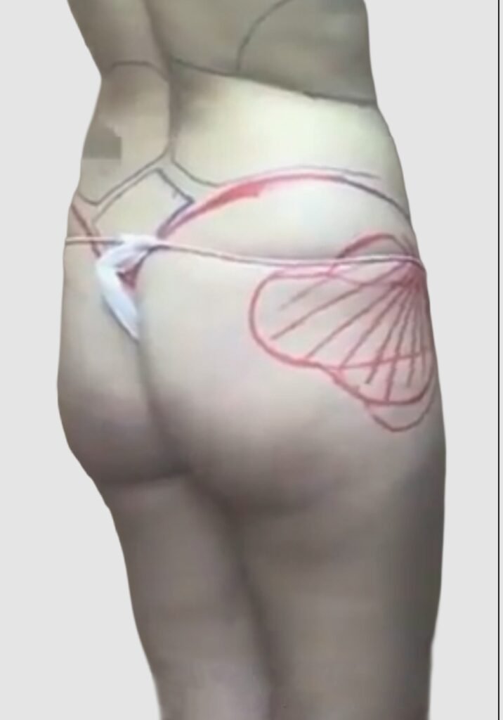 Before and after results of BBL procedure performed by Dr. Magna. before