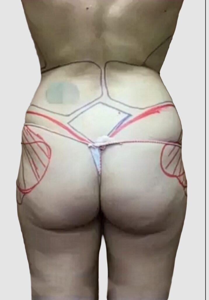 Before and after results of BBL procedure performed by Dr. Magna. before