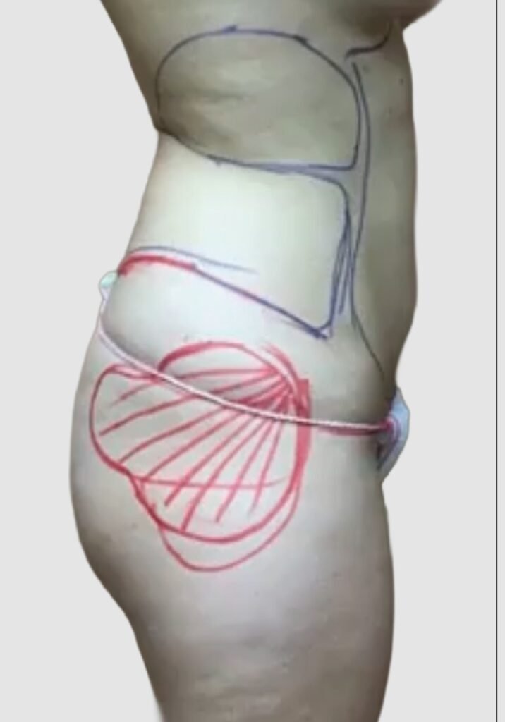 Before and after results of abdominal/flank liposuction performed by Dr. Magna. before