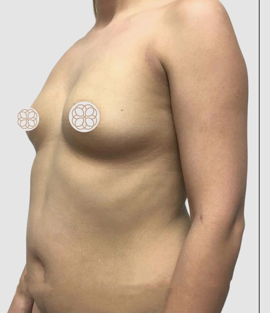Before and after results of breast augmentation performed by Dr. Magna. before