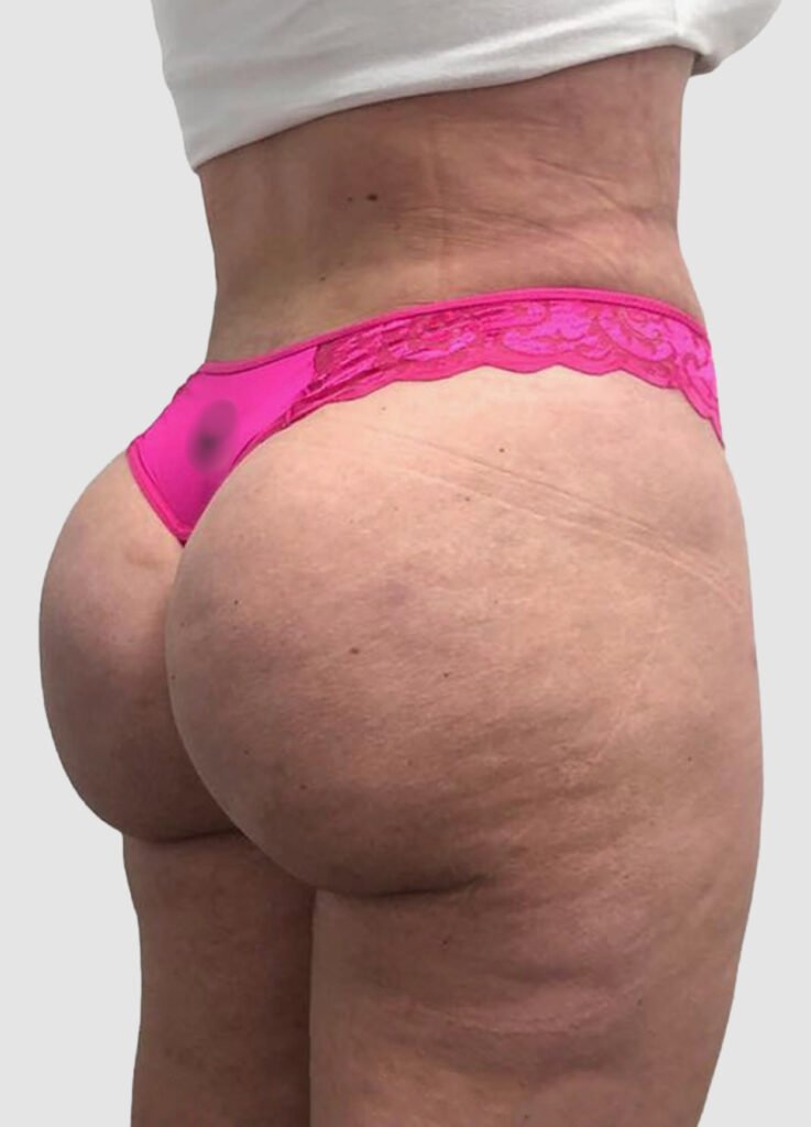 Before and after results of BBL procedure performed by Dr. Magna. after