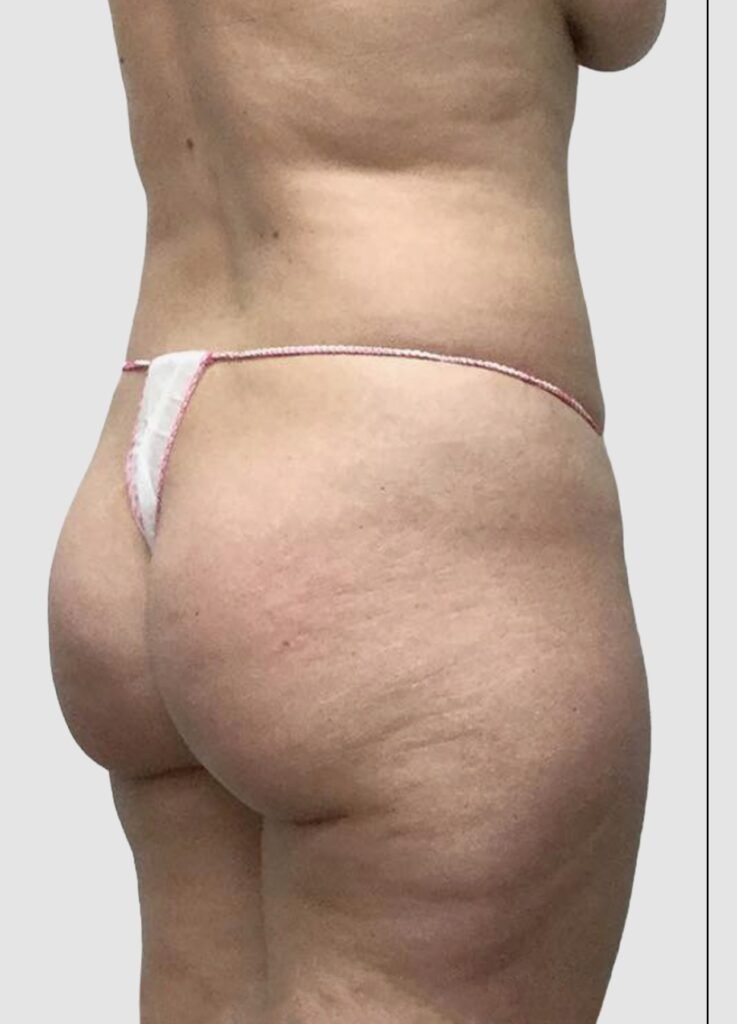 Before and after results of BBL procedure performed by Dr. Magna. before