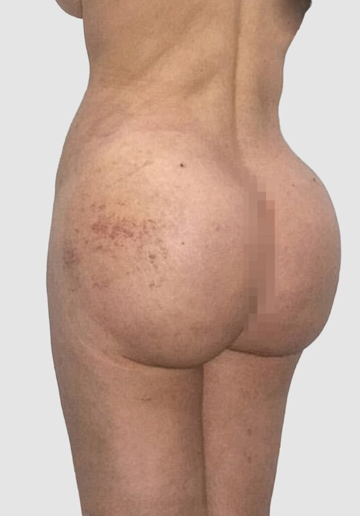 Before and after results of BBL procedure performed by Dr. Magna. after