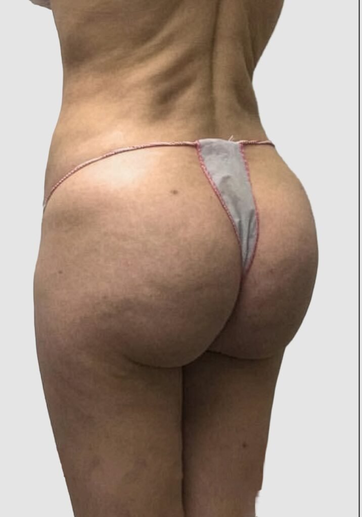 Before and after results of BBL procedure performed by Dr. Magna. before