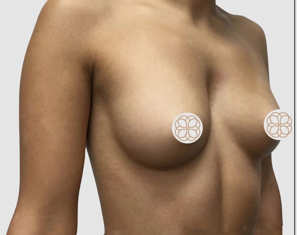 Before and after results of breast augmentation performed by Dr. Magna. before