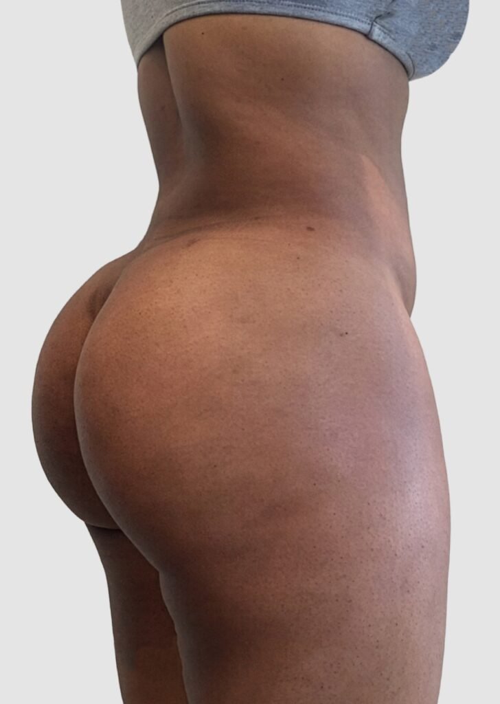 Before and after results of BBL procedure performed by Dr. Magna. after