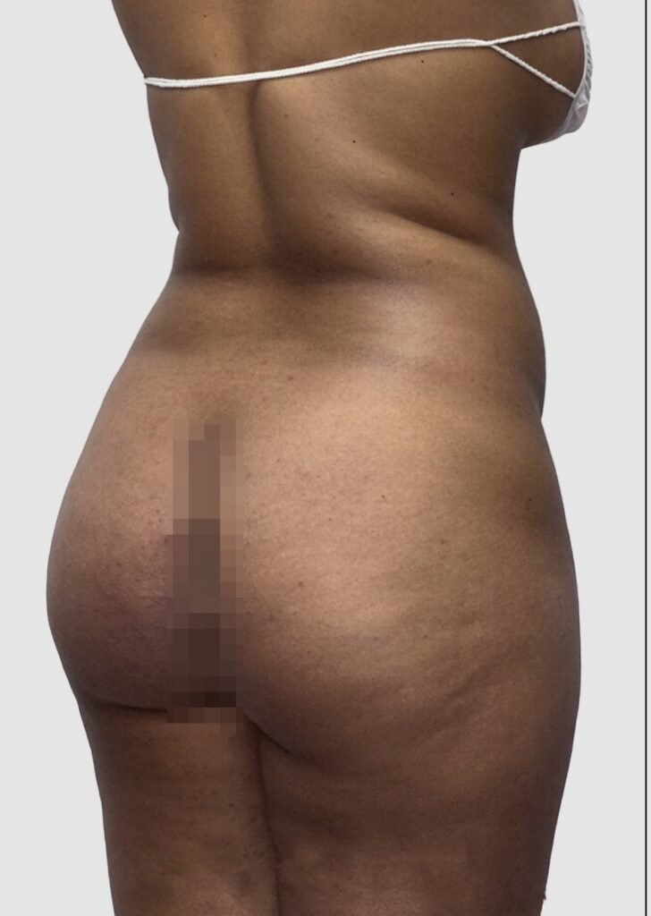 Before and after results of BBL procedure performed by Dr. Magna. before
