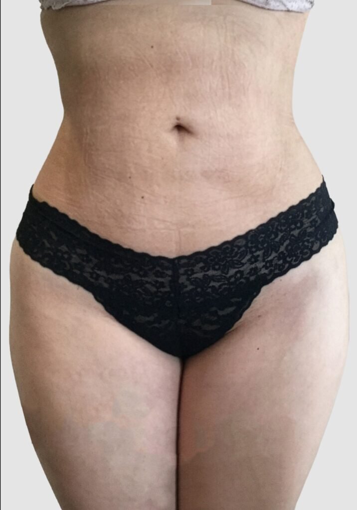 Before and after results of abdominal liposuction performed by Dr. Magna. after