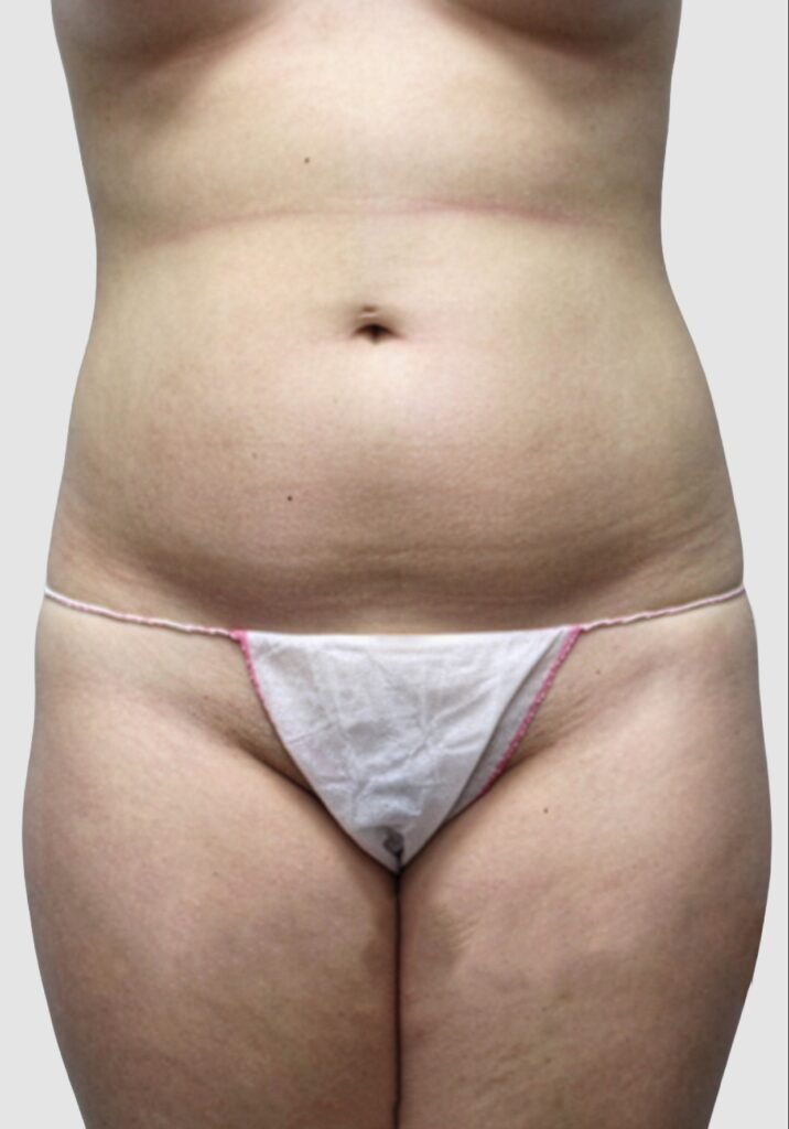 Before and after results of abdominal liposuction performed by Dr. Magna. before