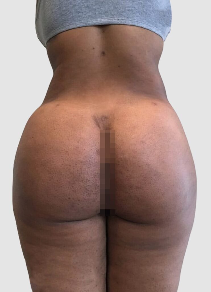 Before and after results of BBL procedure performed by Dr. Magna. after