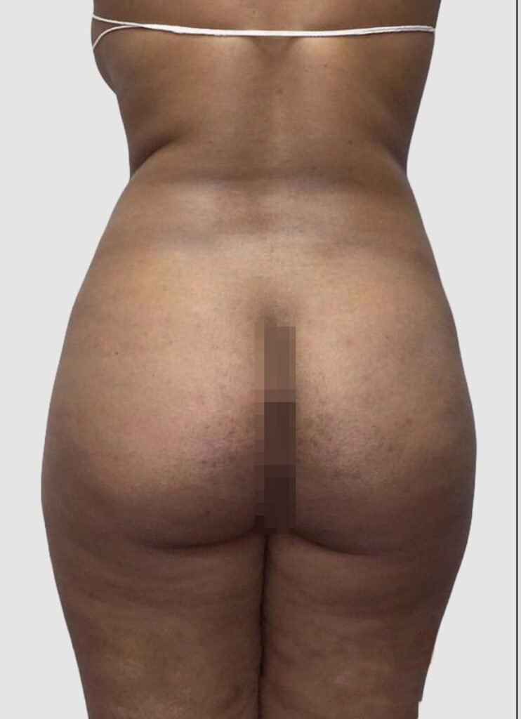 Before and after results of BBL procedure performed by Dr. Magna. before