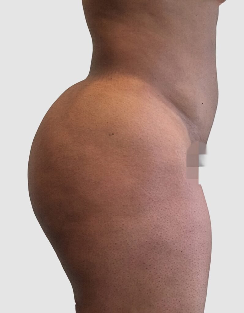 Before and after results of BBL procedure performed by Dr. Magna. after