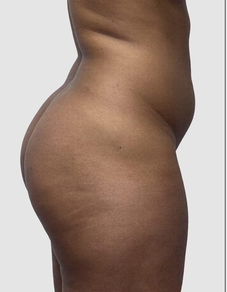Before and after results of BBL procedure performed by Dr. Magna. before
