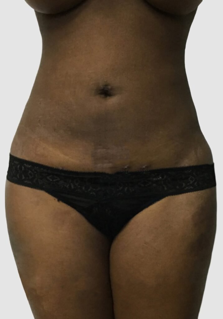 Before and after results of abdominal liposuction performed by Dr. Magna. after