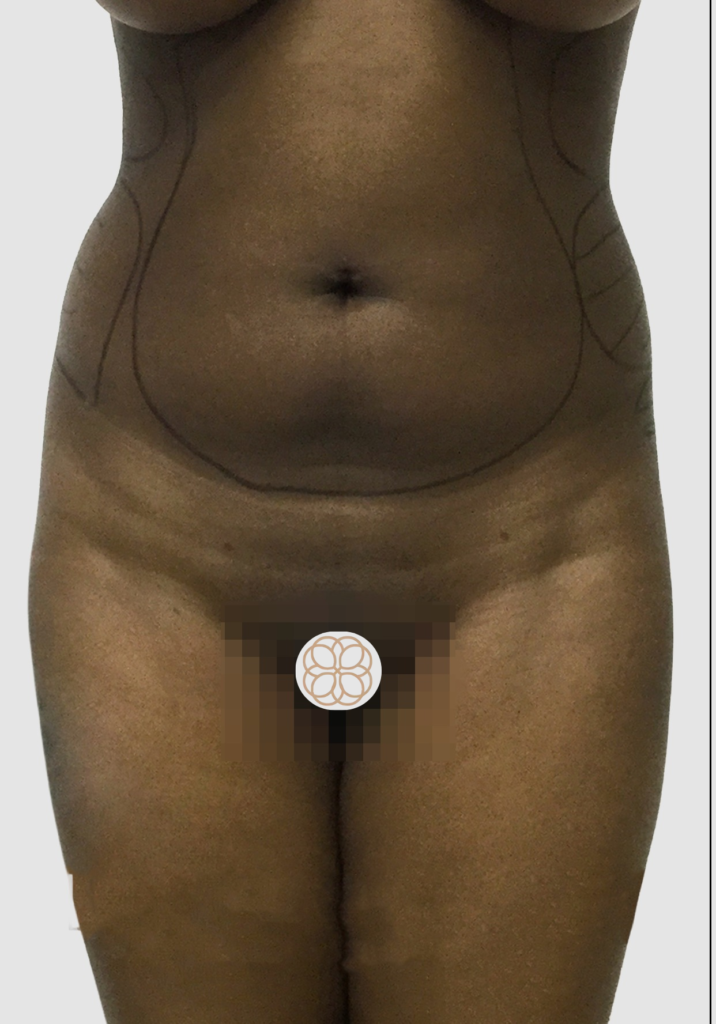 Before and after results of abdominal liposuction performed by Dr. Magna. before