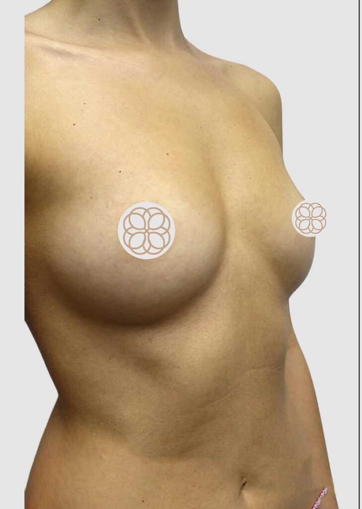 Before and after results of breast augmentation performed by Dr. Magna. before