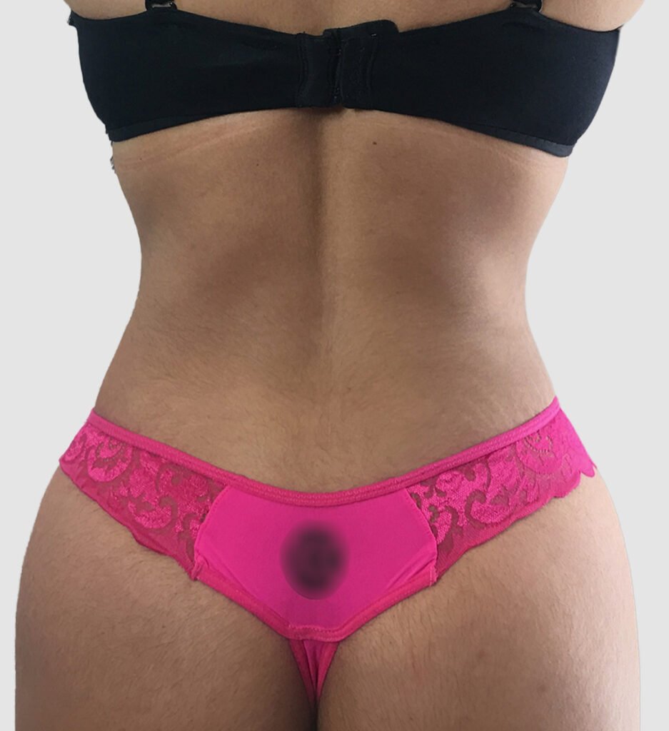 Before and after results of flanks and back liposuction performed by Dr. Magna. after