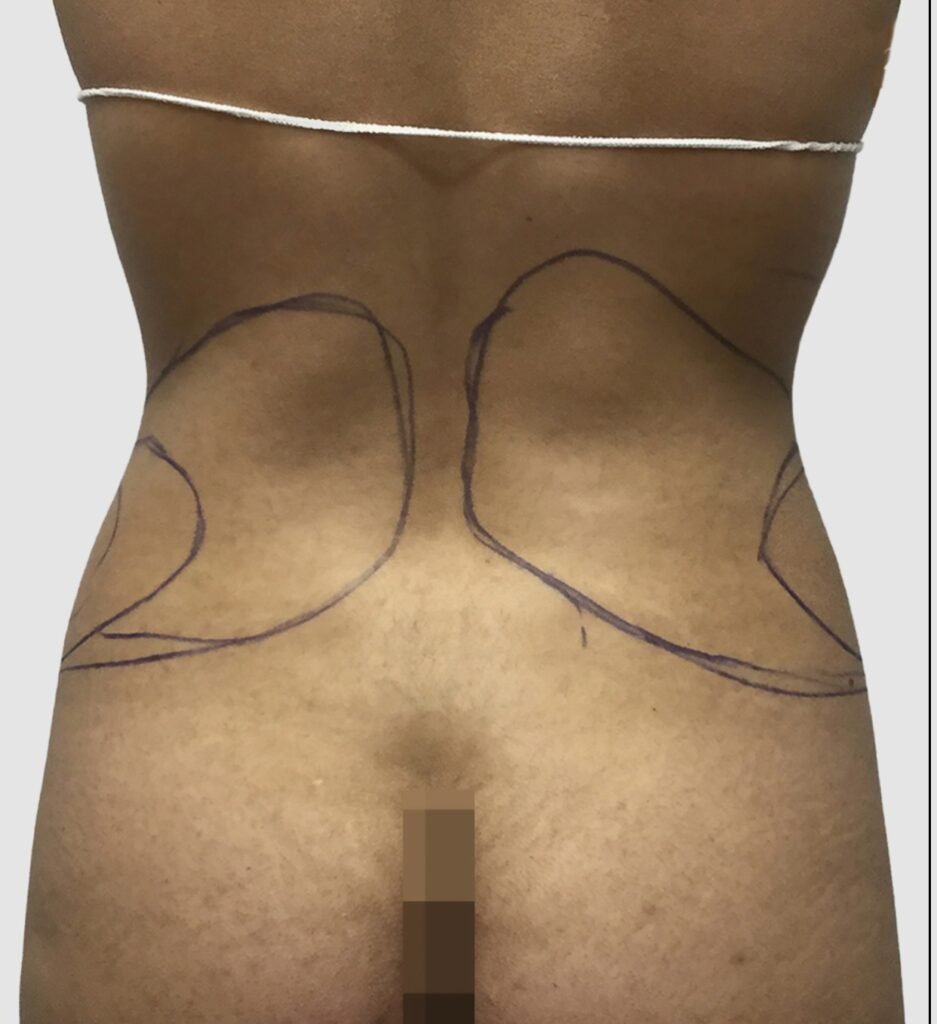 Before and after results of flanks and back liposuction performed by Dr. Magna. before