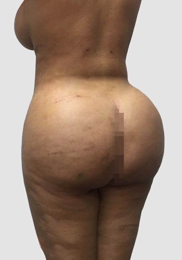 Before and after results of BBL procedure performed by Dr. Magna. after
