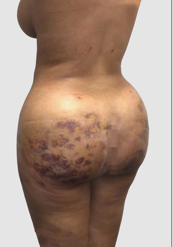 Before and after results of BBL procedure performed by Dr. Magna. before