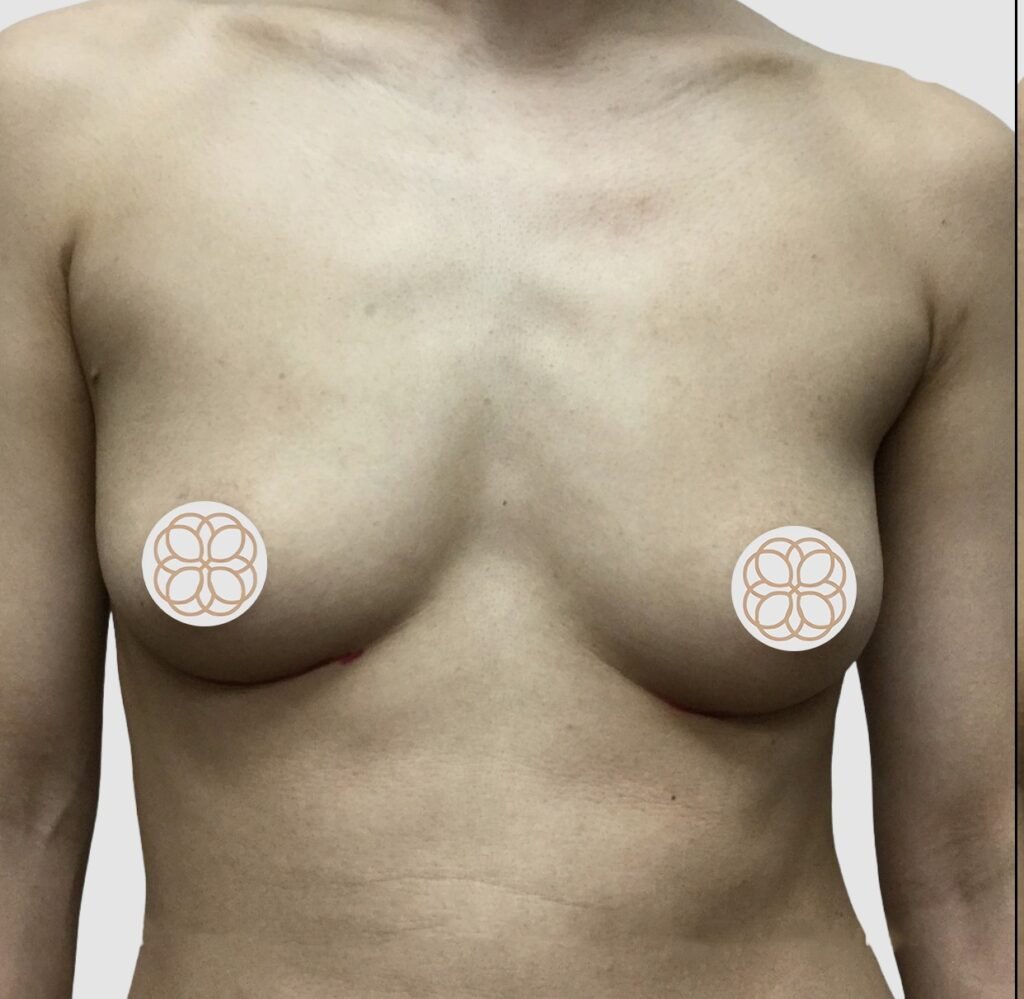 Before and after results of breast augmentation performed by Dr. Magna. before
