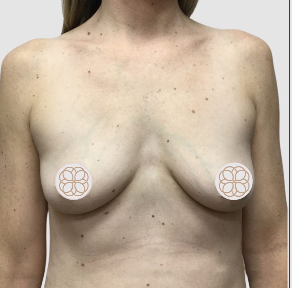 Before and after results of breast augmentation performed by Dr. Magna. before