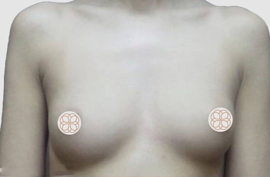Before and after results of breast augmentation performed by Dr. Magna. before
