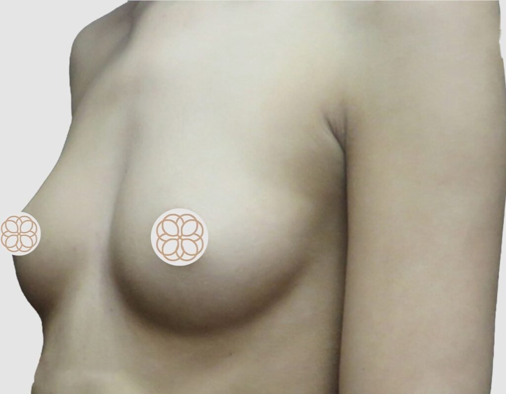 Before and after results of breast augmentation performed by Dr. Magna. before