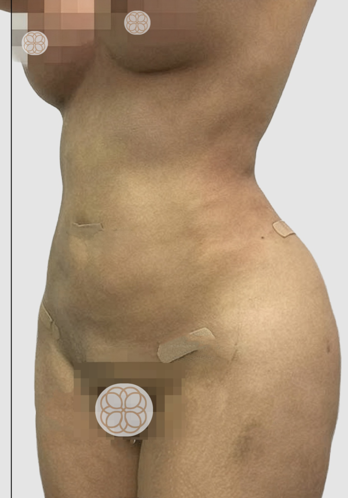 Before and after results of abdominal liposuction performed by Dr. Magna. after