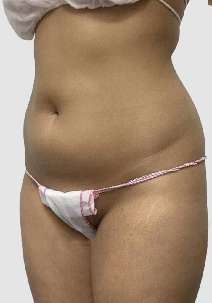 Before and after results of abdominal liposuction performed by Dr. Magna. before