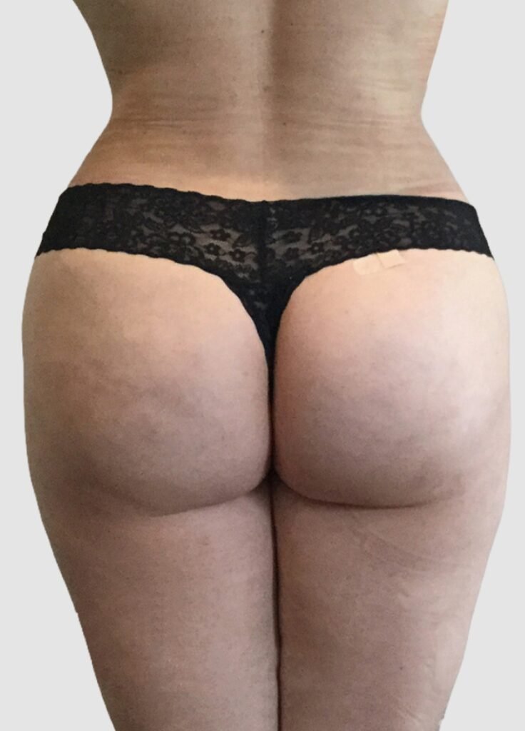 Before and after results of BBL procedure performed by Dr. Magna. after