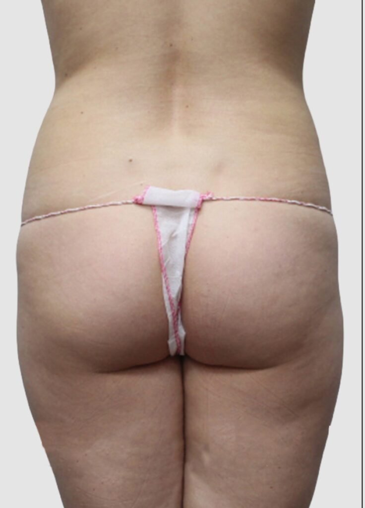 Before and after results of BBL procedure performed by Dr. Magna. before