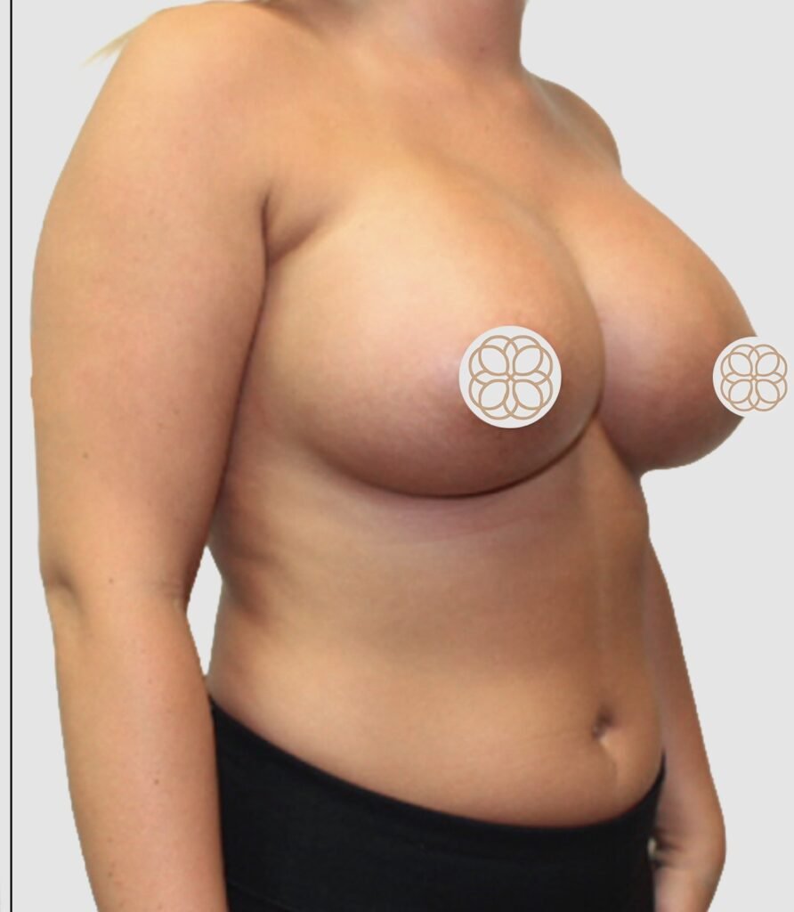 Before and after results of breast augmentation performed by Dr. Magna. after