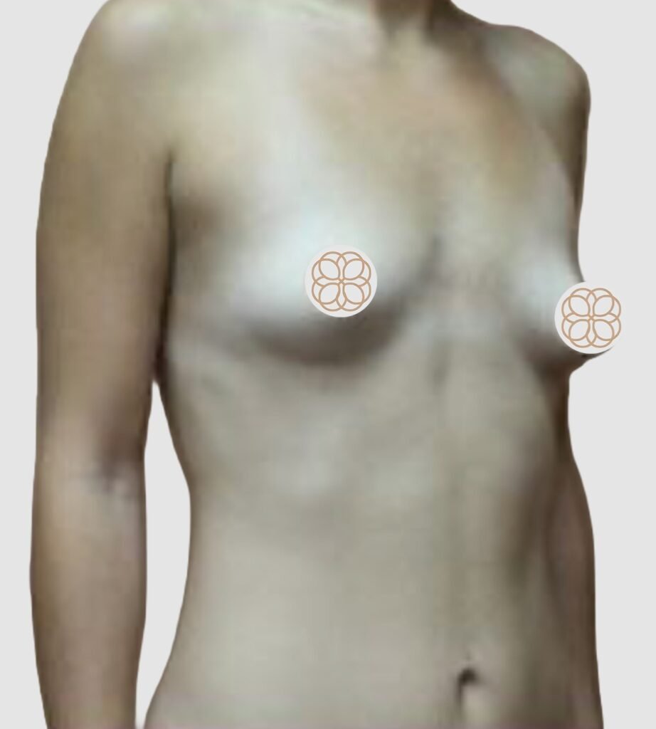 Before and after results of breast augmentation performed by Dr. Magna. before