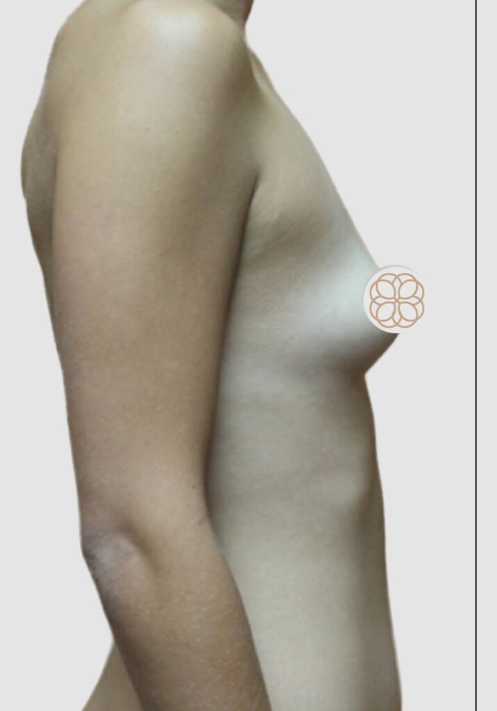 Before and after results of breast augmentation performed by Dr. Magna. before